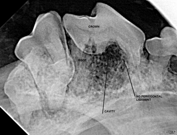 LABELLED CAVITY TOOTH