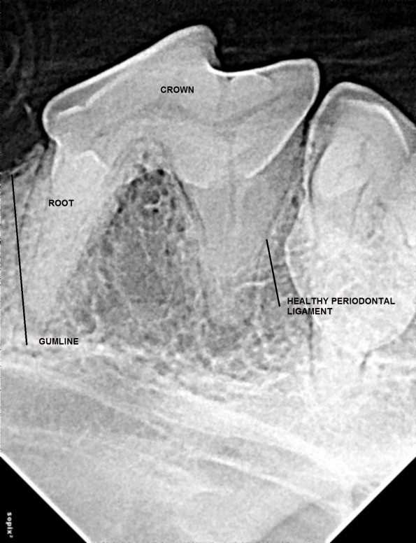 LABELLED HEALTHY TOOTH2